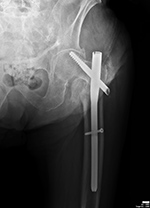 Left hip jatrogenic fracture fixation failure